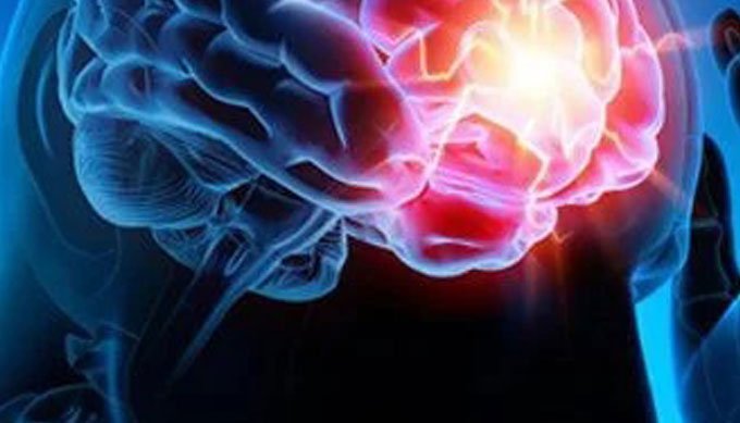 Epilepsy